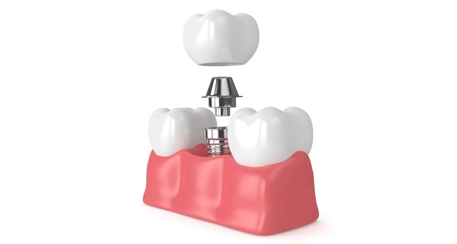 Dental Implantology